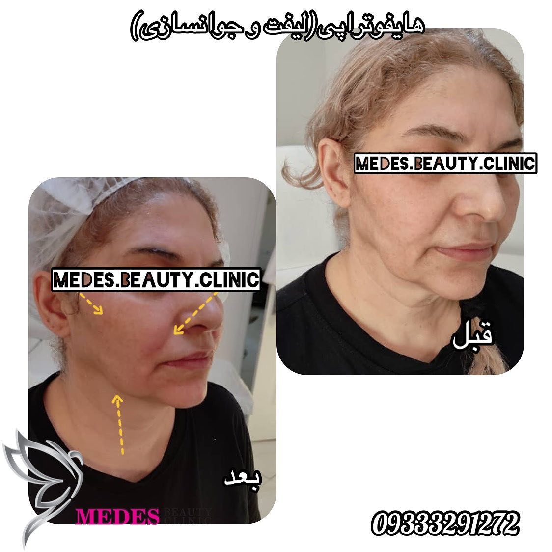 گالری هایفوتراپی